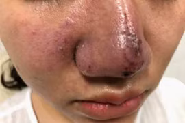 Kinh hoàng ổ mủ trong mũi cô gái 23 tuổi tiêm filler tại spa Hà Nội 