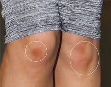 Cách đơn giản hóa phép đầu gối “thâm xì” thành trắng sáng