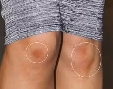 Cách đơn giản hóa phép đầu gối “thâm xì” thành trắng sáng