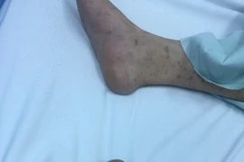 Thiếu nữ Hà Nội 15 tuổi bị vi khuẩn “ăn” não, 14 người khác bị cách ly