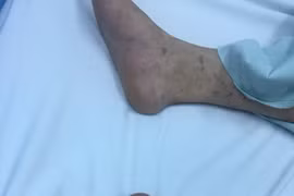 Thiếu nữ Hà Nội 15 tuổi bị vi khuẩn “ăn” não, 14 người khác bị cách ly