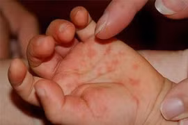 Bến Tre: Bé 2 tuổi tử vong do mắc bệnh tay chân miệng