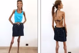 Mơ thành siêu mẫu, cô gái rơi vào bi kịch như bộ xương khô