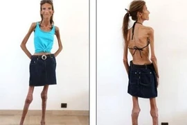 Mơ thành siêu mẫu, cô gái rơi vào bi kịch như bộ xương khô