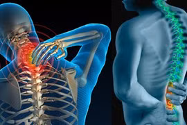 Chữa gai cột sống với những bài thuốc dân gian cực đơn giản