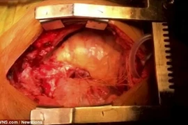 Kỳ lạ hai trái tim chung nhịp đập trong cùng một cơ thể 