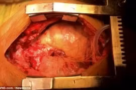 Kỳ lạ hai trái tim chung nhịp đập trong cùng một cơ thể 