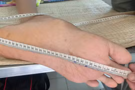 Nam thanh niên người Việt bất ngờ cao 2,5m sau đợt sốt kéo dài