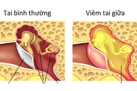 Viêm tai giữa ở trẻ em, cẩn thận biến chứng nguy hiểm