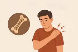 Vì sao người trẻ khoẻ cũng có nguy cơ loãng xương?