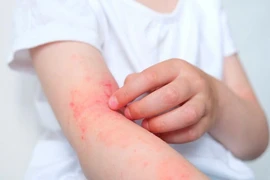 Các yếu tố làm nặng thêm viêm da cơ địa, cách phòng ngừa