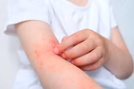 Các yếu tố làm nặng thêm viêm da cơ địa, cách phòng ngừa