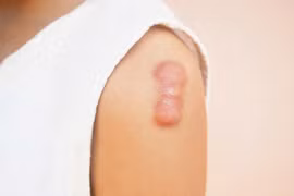 Cách điều trị sẹo sau bỏng