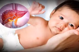 Nguy cơ viêm gan bí ẩn ở trẻ em, dấu hiệu cần lưu ý
