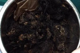 Kỳ lạ cô bé ăn tóc trong suốt 6 tháng ròng