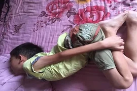 Kỳ lạ cậu bé đau bụng suốt 10 năm đến vẹo cột sống
