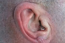 3 loại khối u tai phổ biến