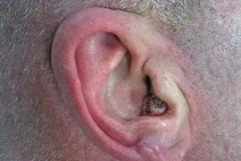 3 loại khối u tai phổ biến