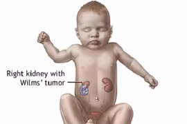 7 dạng ung thư ác tính thường gặp ở trẻ em 