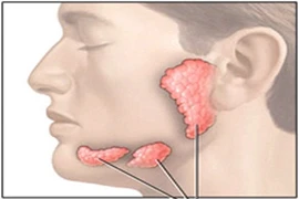 Các loại ung thư đầu cổ thường gặp (2)