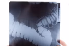 Thử nghiệm đơn giản phát hiện hầu hết ung thư ruột