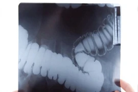 Thử nghiệm đơn giản phát hiện hầu hết ung thư ruột