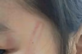 Xác minh vụ việc nhiều bé mầm non bị bạn đánh bầm tím