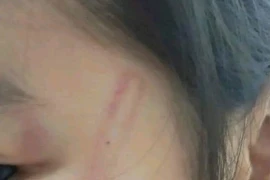 Xác minh vụ việc nhiều bé mầm non bị bạn đánh bầm tím