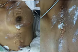 Cứu sống một phụ nữ mang thai bị sét đánh