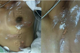 Cứu sống một phụ nữ mang thai bị sét đánh