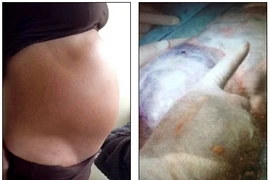 Kinh hoàng u nang buồng trứng nặng 10kg