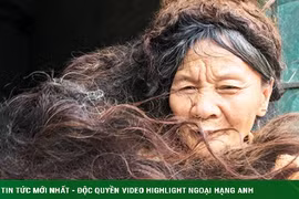 Người phụ nữ có mái tóc kì dị: Kết thành nhiều mảng, cứ cắt là đổ bệnh