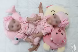 ​100 nhân viên y tế tham gia ca mổ tách dính song sinh hiếm gặp