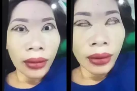 Ám ảnh pha cắt mí mắt 'lợn lành thành lợn què'