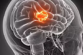 Đột phá: Dùng kim dài và điện hạ gục bệnh ung thư