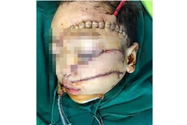 Bé trai 5 tuổi bị cha chém nát mặt, nguy kịch