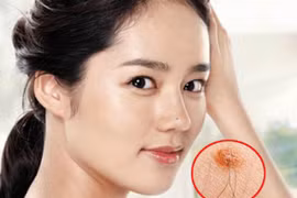 4 vị trí mọc lông dự báo số đại gia, chớ dại nhổ đi