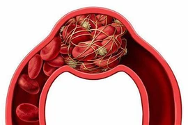 Hình thành cục máu đông hệ lụy báo động cho sức khỏe