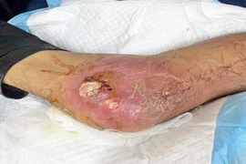 Người đàn ông biến chứng suy tuyến thượng thận do lạm dụng thuốc chứa corticoid