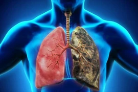 Những hiểu lầm thường gặp trong ung thư phổi