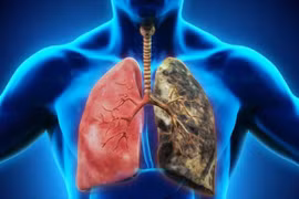 Những hiểu lầm thường gặp trong ung thư phổi