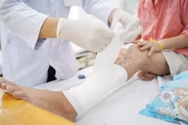 Trong khuôn khổ hợp tác nghiên cứu giữa bệnh viện Chợ Rẫy và Viện CSIRO (Úc) 2 bên đã thống nhất tiến hành thiết kế và in mảnh ghép cá thể hoá sản để điều trị cho bệnh nhân bị mất một đoạn xương dài do gẫy hở nhiễm trùng.