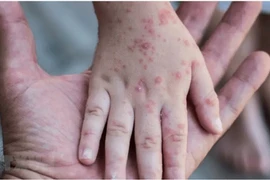 Bộ Y tế: Báo cáo kịp thời trường hợp nghi ngờ, mắc bệnh đậu mùa khỉ