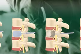 Bác sĩ chỉ rõ các phương pháp điều trị xẹp đốt sống do loãng xương