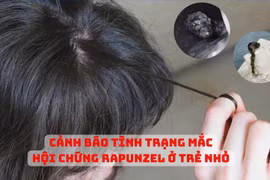 Tắc ruột do “hội chứng ăn tóc”