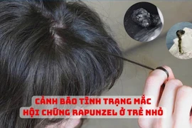 Tắc ruột do “hội chứng ăn tóc”