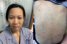 Nhiều người mắc thủy đậu… cẩn thận biến chứng đe dọa tính mạng