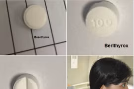 Điều trị Basedow không đúng cách, bệnh nhân suy tim, rung nhĩ đe dọa tính mạng