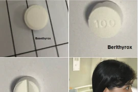 Điều trị Basedow không đúng cách, bệnh nhân suy tim, rung nhĩ đe dọa tính mạng