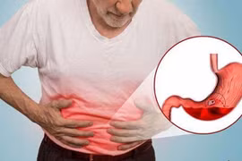 Bác sĩ chỉ rõ thói quen khiến chữa dạ dày mãi không khỏi